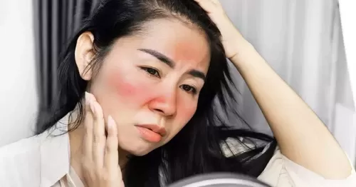 Lupus ban đỏ