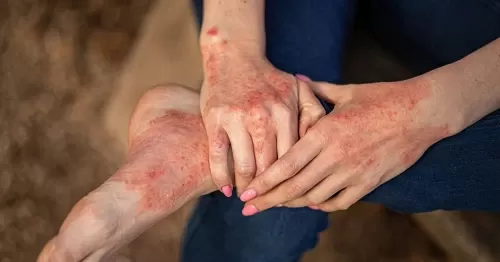 Viêm da cơ địa